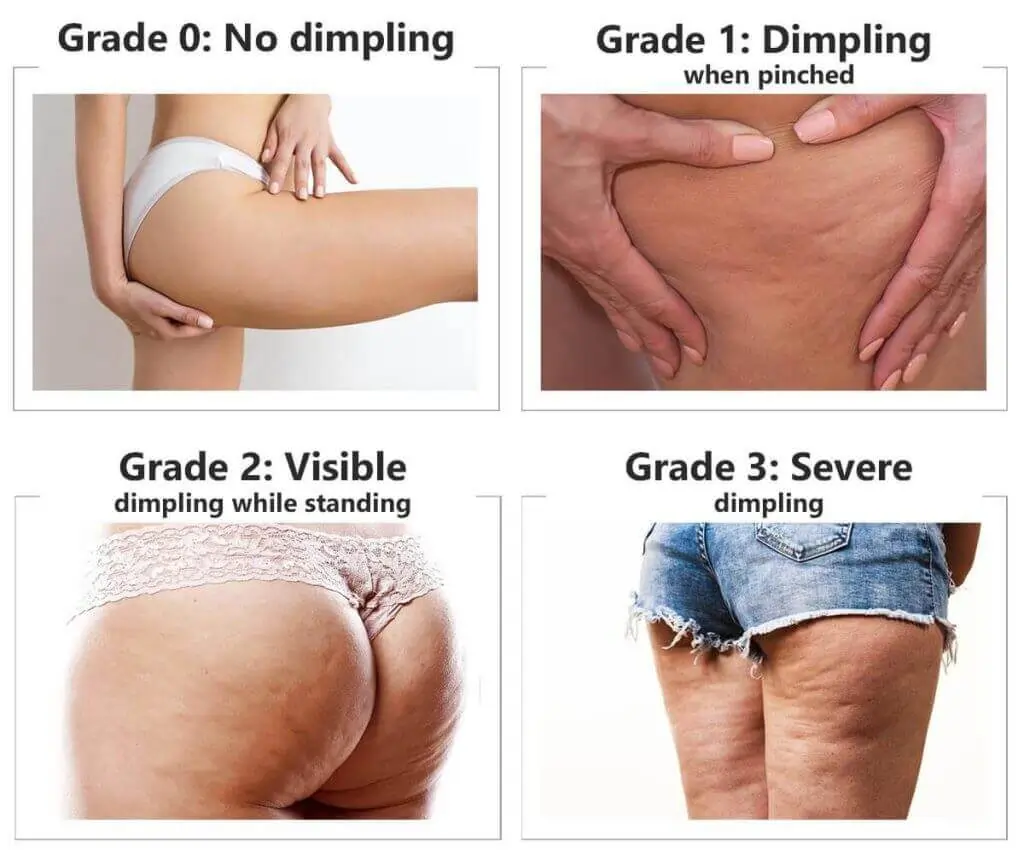 Representation of the stages of cellulite development Redhill